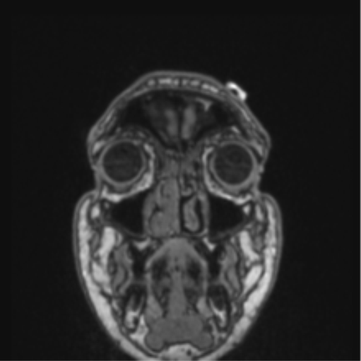 Cerebellar hemangioblastomas and pituitary adenoma (Radiopaedia 85490-101176 Coronal T1 83).png