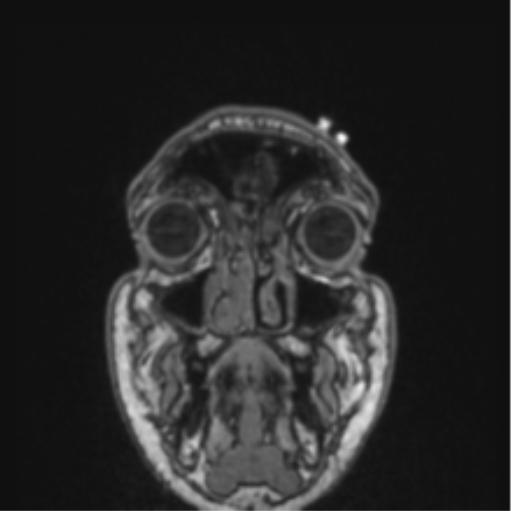 Cerebellar hemangioblastomas and pituitary adenoma (Radiopaedia 85490-101176 Coronal T1 84).png