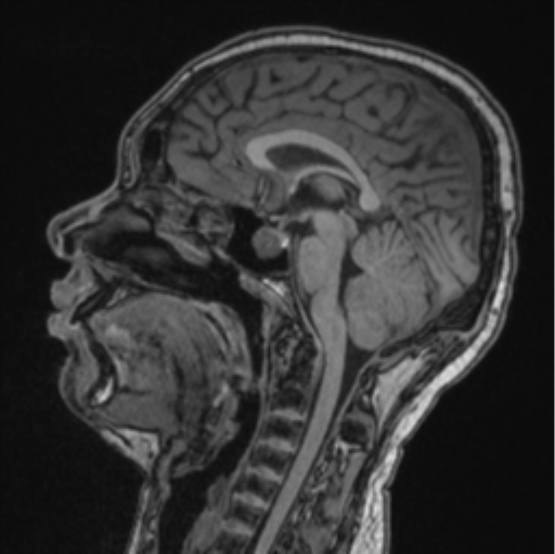 File:Cerebellar hemangioblastomas and pituitary adenoma (Radiopaedia 85490-101176 Sagittal T1 52).png