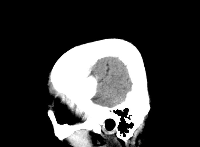 File:Cerebellar hemorrhage (Radiopaedia 37000-38671 A 30).png