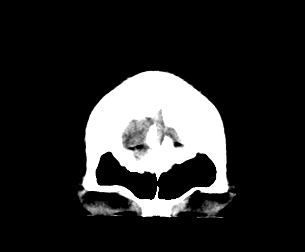 File:Cerebellar infarct due to vertebral artery dissection with posterior fossa decompression (Radiopaedia 82779-97032 Coronal non-contrast 5).png