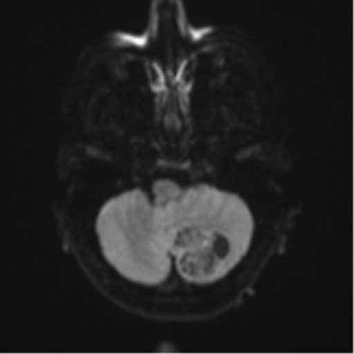 Cerebellar metastasis (Radiopaedia 51137-56765 Axial DWI 34).png