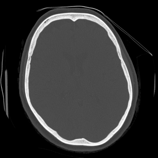 Cerebellar metastasis (cystic appearance) (Radiopaedia 41395-44258 Axial bone window 39).png