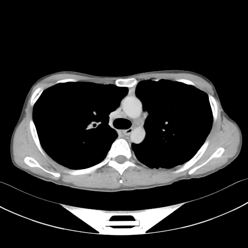 Cerebellar metastasis - adenocarcinoma lung (Radiopaedia 63184-71717 Axial C+ delayed 25).png