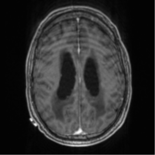 File:Cerebellar metastasis from lung adenocarcinoma (Radiopaedia 86690-102829 Axial T1 C+ 54).png