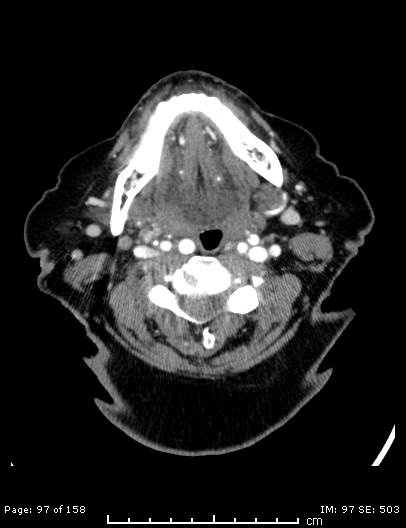 Cerebellar strokes due to intracranial giant cell arteritis (Radiopaedia 68799-78510 CT angiogram 97).jpg