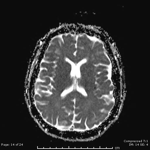 File:Cerebellar strokes due to intracranial giant cell arteritis (Radiopaedia 68799-81713 Axial ADC 14).jpg