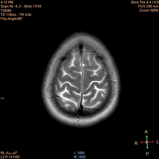 File:Cerebellopontine angle meningioma (Radiopaedia 22488-22525 Axial T2 15).jpg