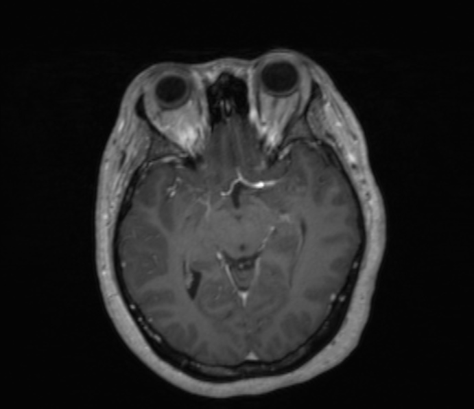 Cerebellopontine angle meningioma (Radiopaedia 35181-36715 Axial T1 C+ 32).jpg