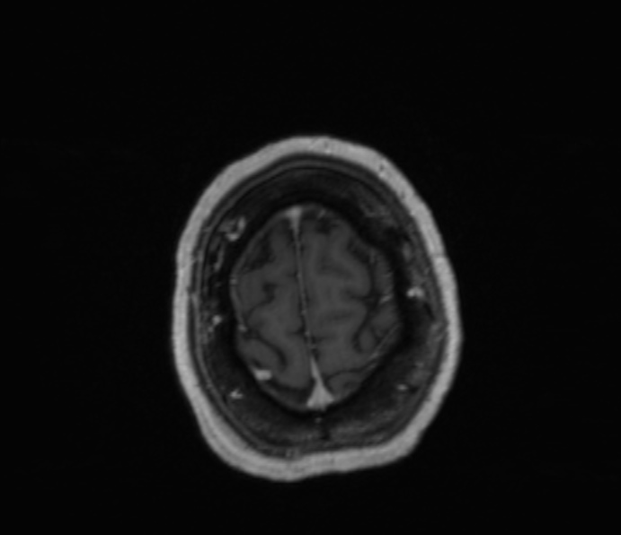 Cerebellopontine angle meningioma (Radiopaedia 35181-36715 Axial T1 C+ 9).jpg