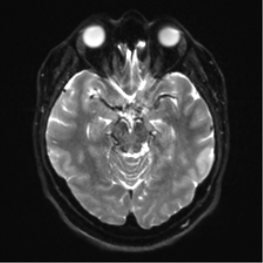Cerebellopontine angle meningioma (Radiopaedia 48434-53348 Axial DWI 15).png