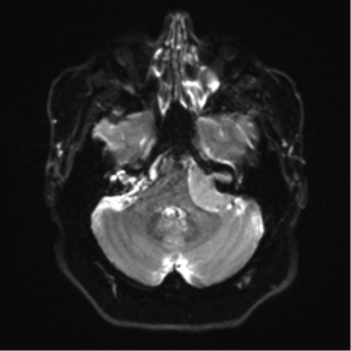 Cerebellopontine angle meningioma (Radiopaedia 48434-53348 Axial DWI 9).png
