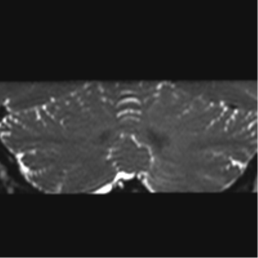 Cerebellopontine angle meningioma (Radiopaedia 48434-53348 Coronal T2 11).png