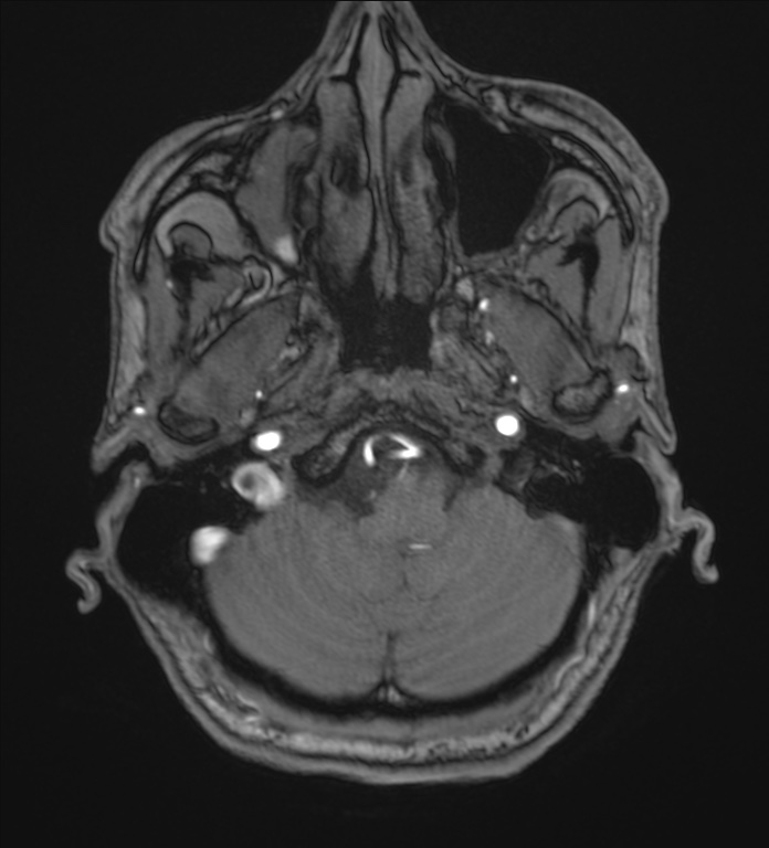 Cerebellopontine angle meningioma (Radiopaedia 72983-83680 Axial MRA 13).jpg