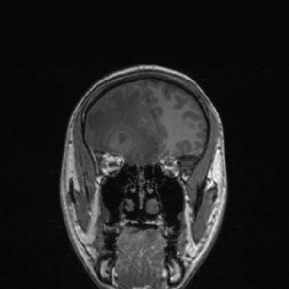 Cerebral abscess (Radiopaedia 24212-24478 Coronal T1 64).jpg