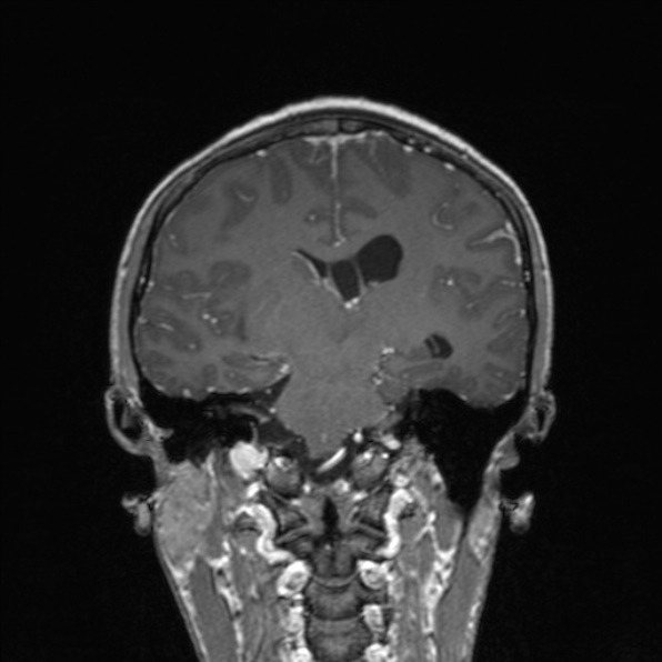 Cerebral abscess (Radiopaedia 24212-24478 Coronal T1 C+ 122).jpg