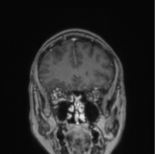 Cerebral abscess from pulmonary arteriovenous malformation (Radiopaedia 86275-102291 L 67).png