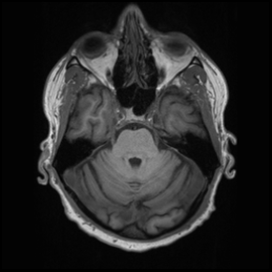 File:Cerebral abscess with ventriculitis (Radiopaedia 78965-91878 Axial T1 14).jpg