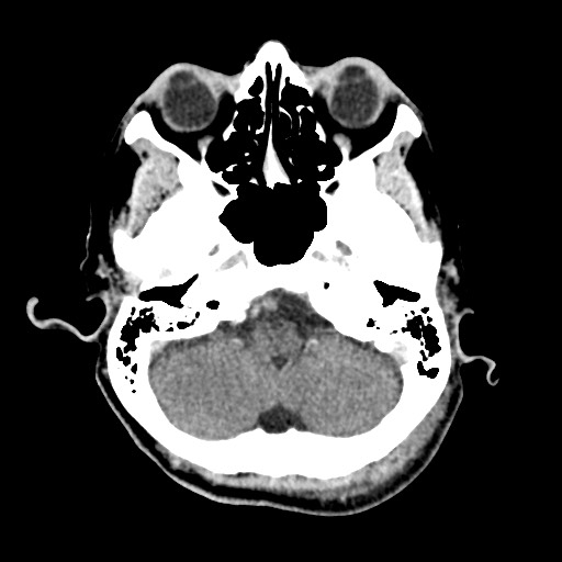 File:Cerebral amyloid angiopathy-related inflammation (Radiopaedia 74836-85848 Axial non-contrast 14).jpg