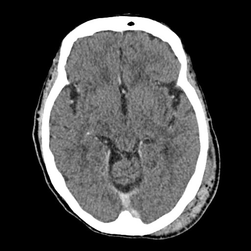 Cerebral amyloid angiopathy-related inflammation (Radiopaedia 74836-85848 Axial non-contrast 28).jpg