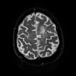 Cerebral amyloid angiopathy (Radiopaedia 28698-28978 Axial DWI 52).jpg