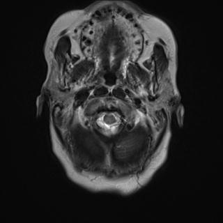File:Cerebral amyloid angiopathy (Radiopaedia 29129-29518 Axial T2 1).jpg