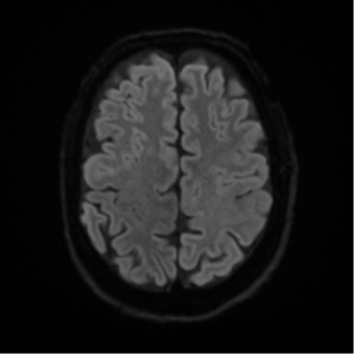 Cerebral amyloid angiopathy (Radiopaedia 46082-50433 Axial DWI 47).png