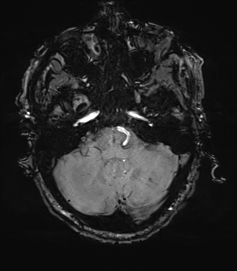 File:Cerebral amyloid angiopathy (Radiopaedia 46082-50433 Axial SWI 17).png