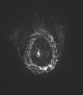 File:Cerebral amyloid angiopathy (Radiopaedia 46082-50433 Axial SWI 87).png