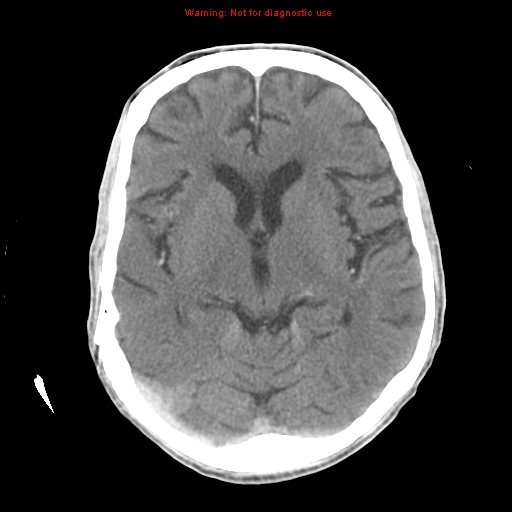 File:Cerebral and orbital tuberculomas (Radiopaedia 13308-13310 B 14).jpg
