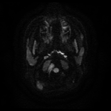File:Cerebral and spinal tuberculosis (Radiopaedia 90489-107837 Axial DWI 3).jpg