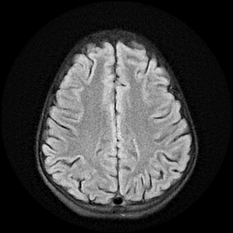 File:Cerebral and spinal tuberculosis (Radiopaedia 90489-107837 Axial FLAIR 16).jpg