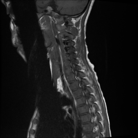 File:Cerebral and spinal tuberculosis (Radiopaedia 90489-107838 Sagittal T1 3).jpg