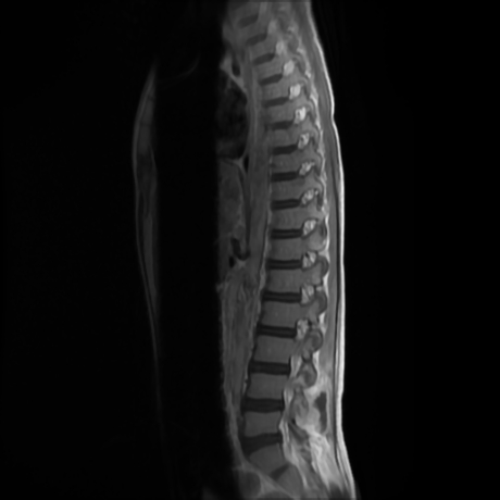 File:Cerebral and spinal tuberculosis (Radiopaedia 90489-107912 Sagittal T1 C+ 4).jpg
