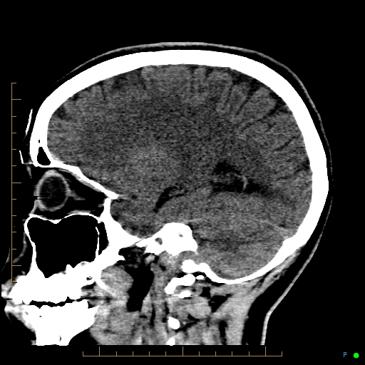Cerebral arteriovenous malformation (AVM) (Radiopaedia 78162-90706 A 52).jpg