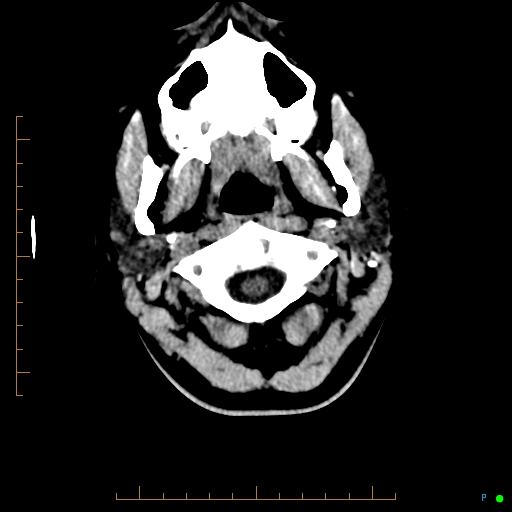 File:Cerebral arteriovenous malformation (AVM) (Radiopaedia 78162-90706 Axial non-contrast 4).jpg
