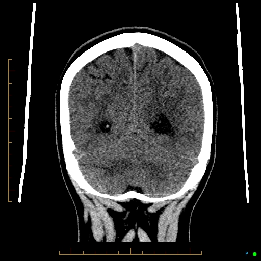 Cerebral arteriovenous malformation (AVM) (Radiopaedia 78162-90706 Coronal non-contrast 75).jpg