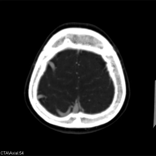 Cerebral arteriovenous malformation (Radiopaedia 28518-28759 B 54).jpg