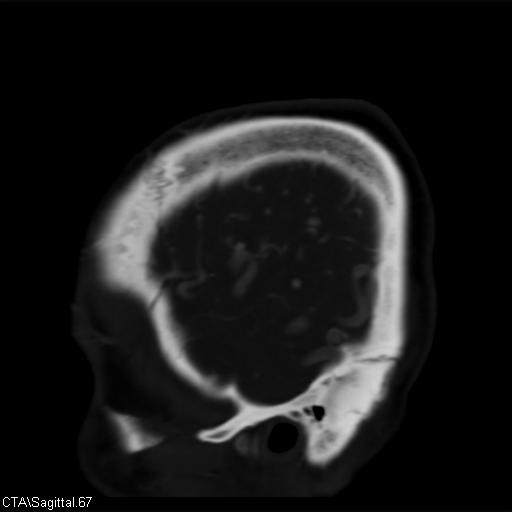 File:Cerebral arteriovenous malformation (Radiopaedia 28518-28759 D 64).jpg