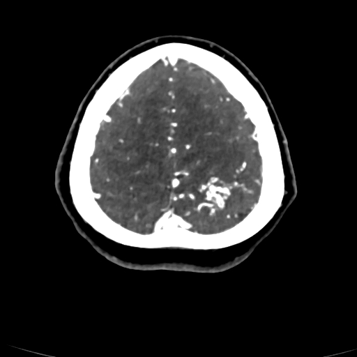 Cerebral arteriovenous malformation (Radiopaedia 73830-84645 Axial C+ delayed 12).jpg
