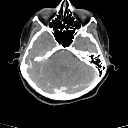 Cerebral arteriovenous malformation (Radiopaedia 73830-84645 B 72).jpg