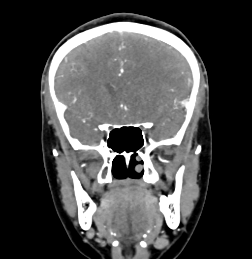 Cerebral arteriovenous malformation (Radiopaedia 73830-84645 C 35).jpg