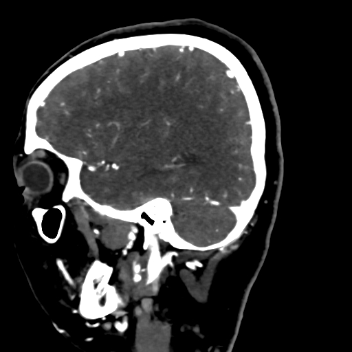 File:Cerebral arteriovenous malformation (Radiopaedia 73830-84645 Sagittal C+ delayed 24).jpg