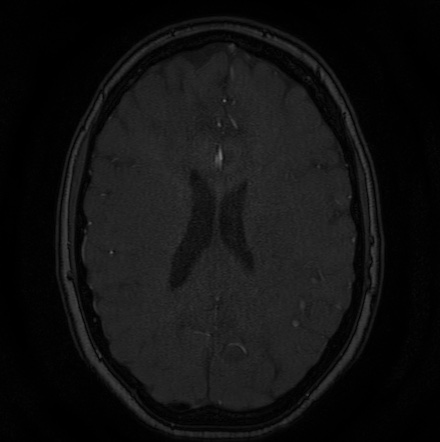 Cerebral arteriovenous malformation (Radiopaedia 74411-85654 Axial MRA 99).jpg