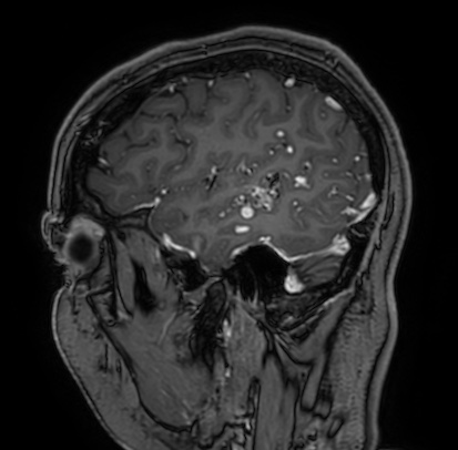 Cerebral arteriovenous malformation (Radiopaedia 74411-85654 Sagittal T1 C+ 20).jpg