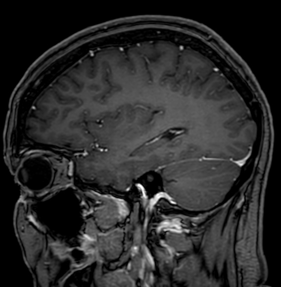 Cerebral arteriovenous malformation (Radiopaedia 74411-85746 Sagittal T1 C+ 33).jpg