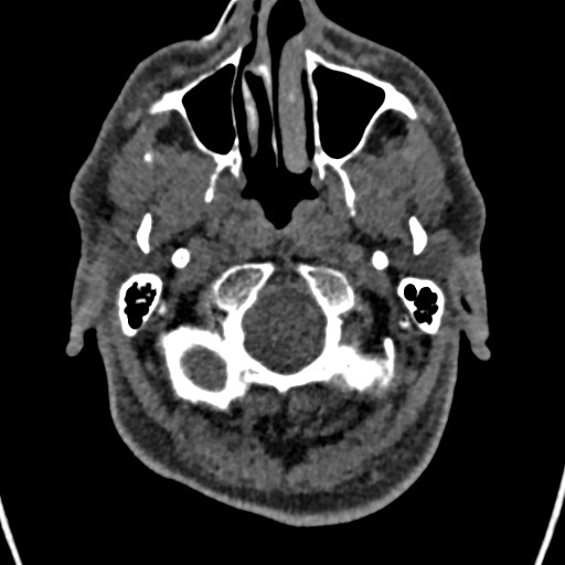 File:Cerebral arteriovenous malformation (Radiopaedia 78188-90746 Axial non-contrast 14).jpg