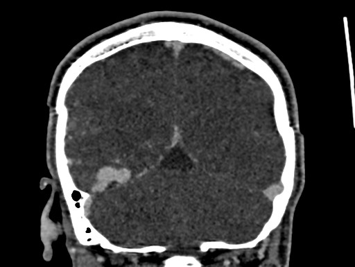 Cerebral arteriovenous malformation (Radiopaedia 78188-90746 Coronal C+ delayed 95).jpg