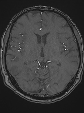 Cerebral arteriovenous malformation (Radiopaedia 84015-99245 Axial TOF 125).jpg