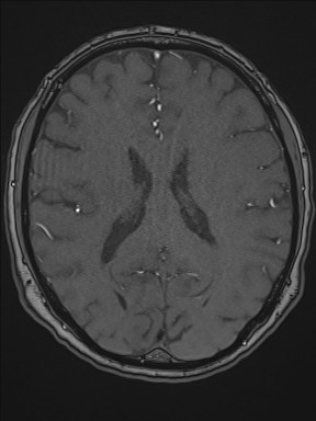 Cerebral arteriovenous malformation (Radiopaedia 84015-99245 Axial TOF 145).jpg